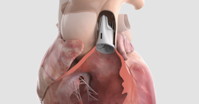 A Heart Valve That Grows With the Child: What the FDA's Landmark Approval Means